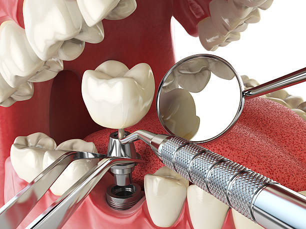 Best Emergency Dentist for Knocked-Out Tooth in Lden, MA